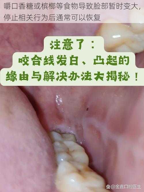 嚼口香糖或槟榔等食物导致脸部暂时变大，停止相关行为后通常可以恢复