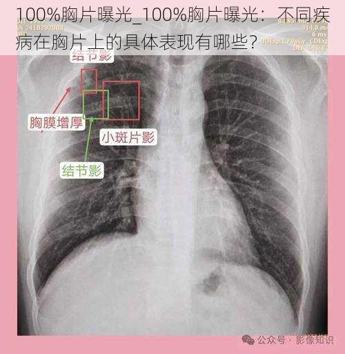 100%胸片曝光_100%胸片曝光：不同疾病在胸片上的具体表现有哪些？